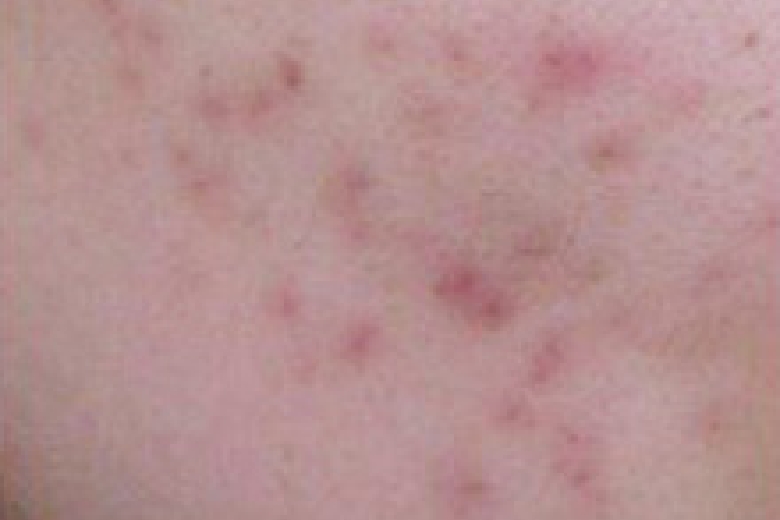 にきびが治って直後の赤紫色、赤褐色の色素沈着