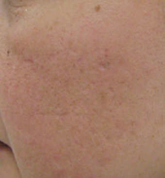 フラクセル3回照射後