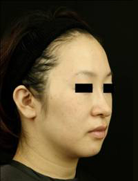 3回治療 3ヶ月後