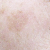 日光製色素斑照射前