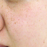 Qスイッチルビーレーザー照射前