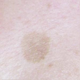 日光性色素斑照射前