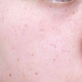 Qスイッチルビーレーザー照射前