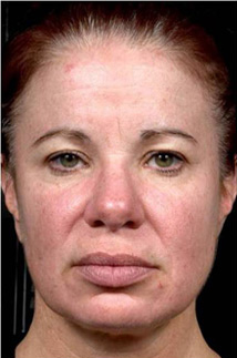 1回治療後、こじわ、毛穴、たるみの改善