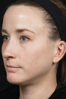 2回治療後色素沈着の改善