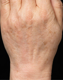 3回治療後老化肌が丸ごと入れ変えによる改善