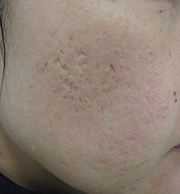 フラクセル照射前