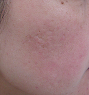 フラクセル3回照射後