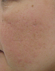 フラクセル3回照射後