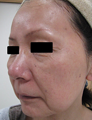 フラクセル照射前