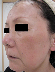 フラクセル照射後