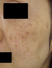 フラクセル照射前