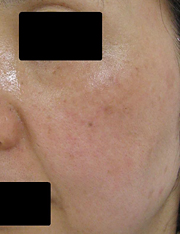 フラクセル4回照射後