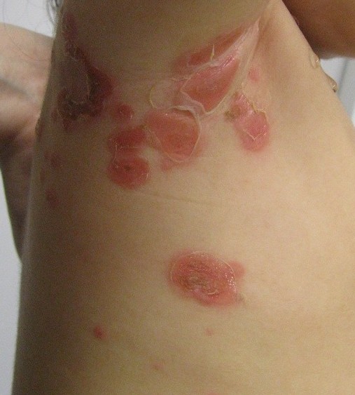 伝染性膿痂疹（とびひ）