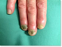 白癬菌（水虫）