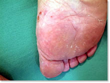 白癬菌（水虫）