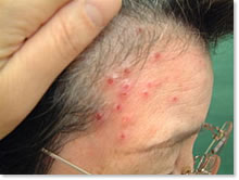 ヘルペス（帯状疱疹、単純疱疹）