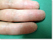 手の湿疹、手荒れ