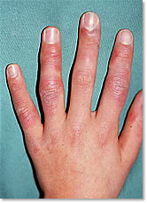 凍瘡（しもやけ）