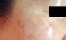 肝斑