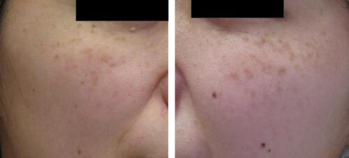 後天性太田母斑